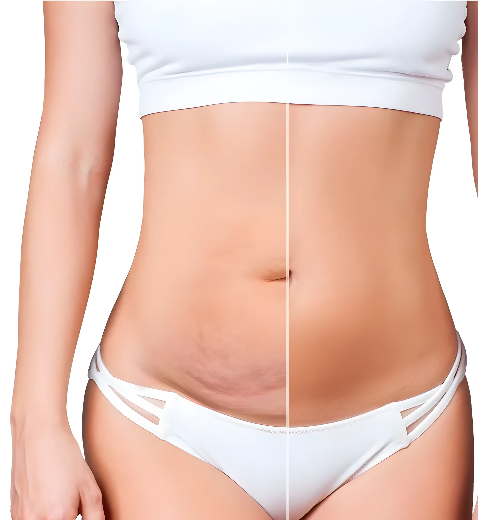 EMSlim – Lumen Estetika