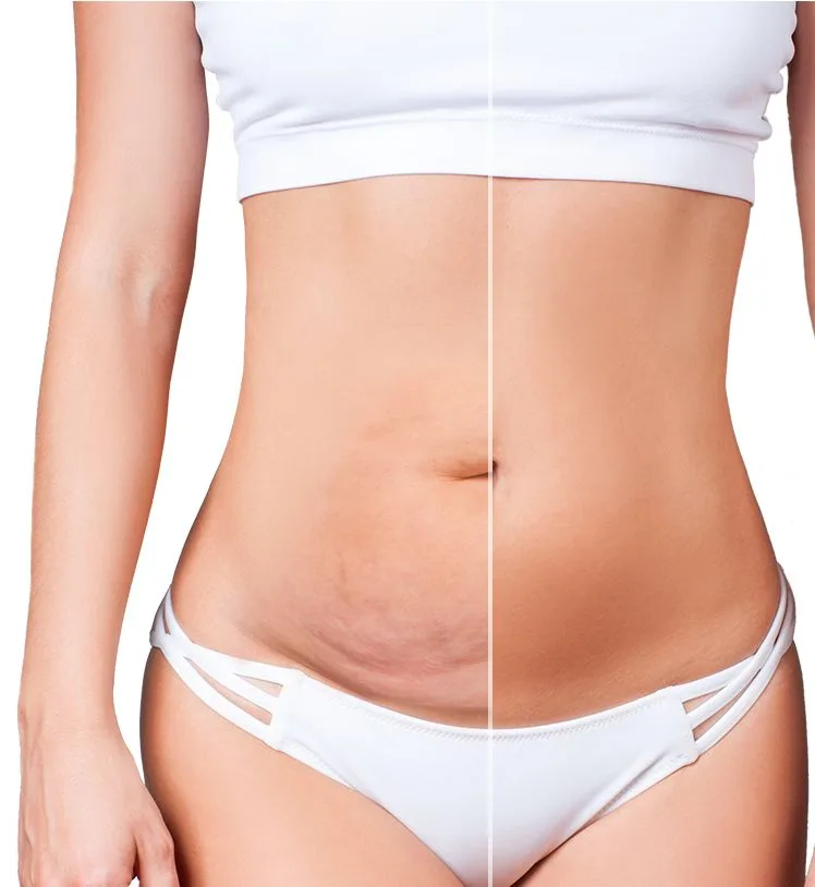 EMS Body Sculpt oblikovanje postave – Celovška 72 Ljubljana